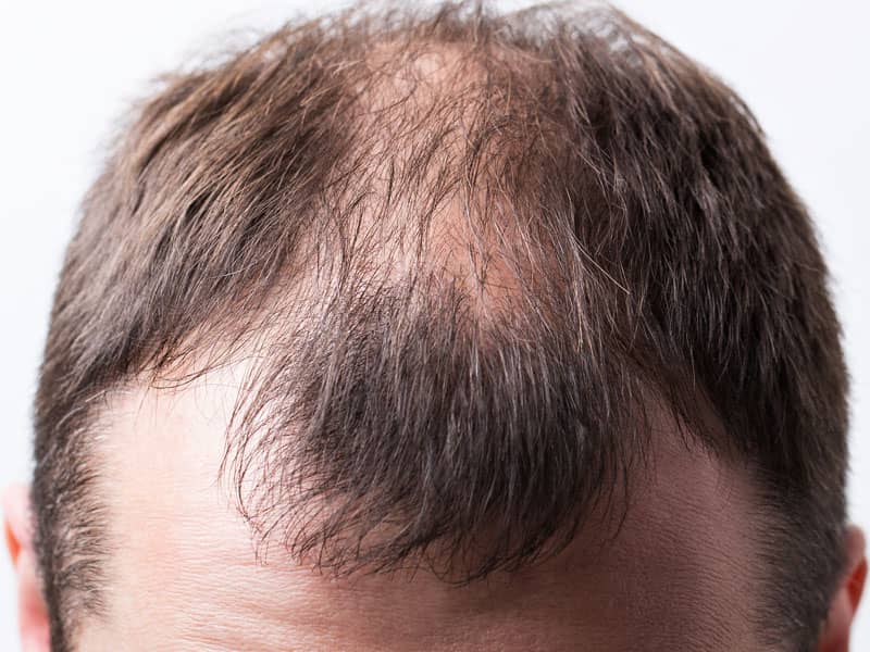 Man suffering hair loss